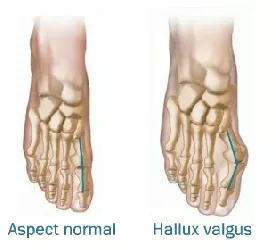 hallux valgus