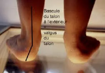 pied plat de l'enfant