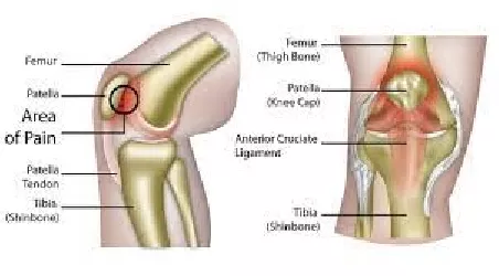 syndrome femoro patellaire 