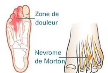 syndrome de Morton