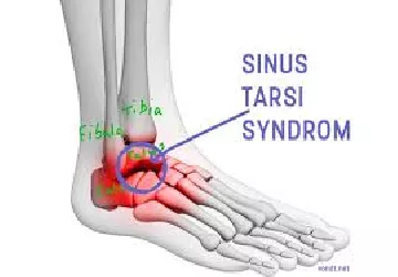 syndrome sinus du tarse